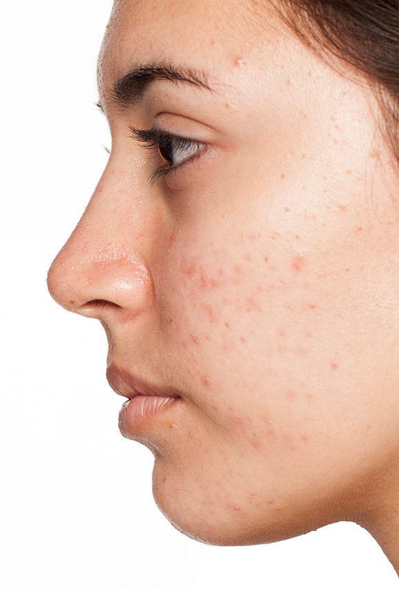Photo of the left side of a woman's face, showing visible acne