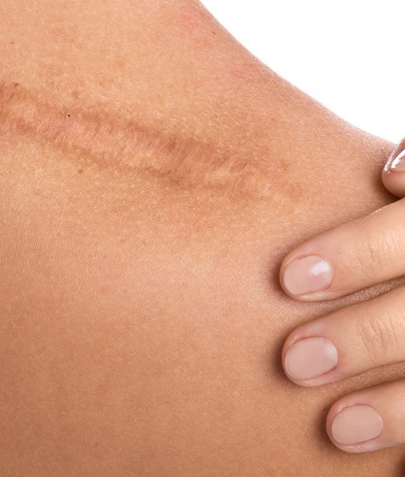 Photo of scars on a woman's shoulder