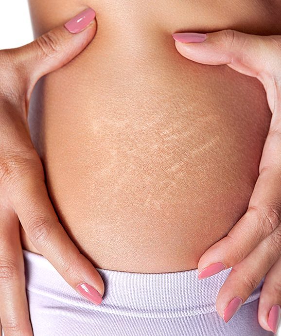 Photo of stretch marks on a woman's skin