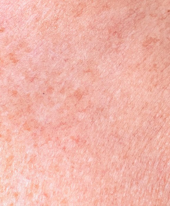 Photo of uneven skin texture