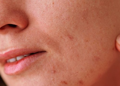 Photo of acne and scarring on a woman's lower face