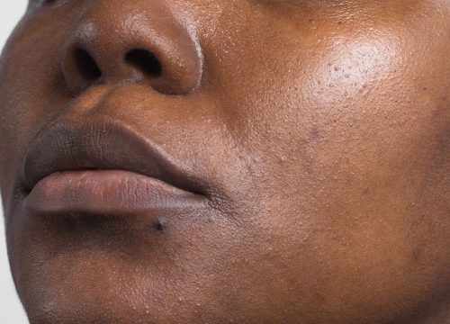 Photo of dull skin on a woman's lower face