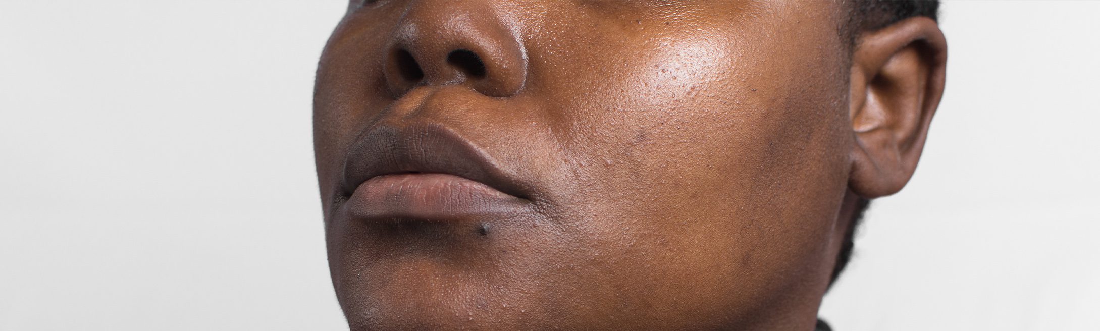 Dull Skin