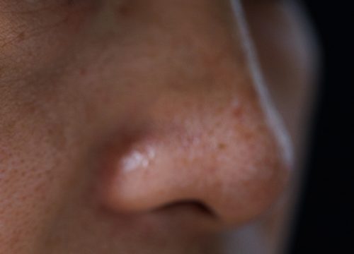 Photo of hyperpigmentation on a woman's cheek