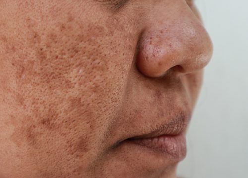 Photo of a melasma on a woman's face