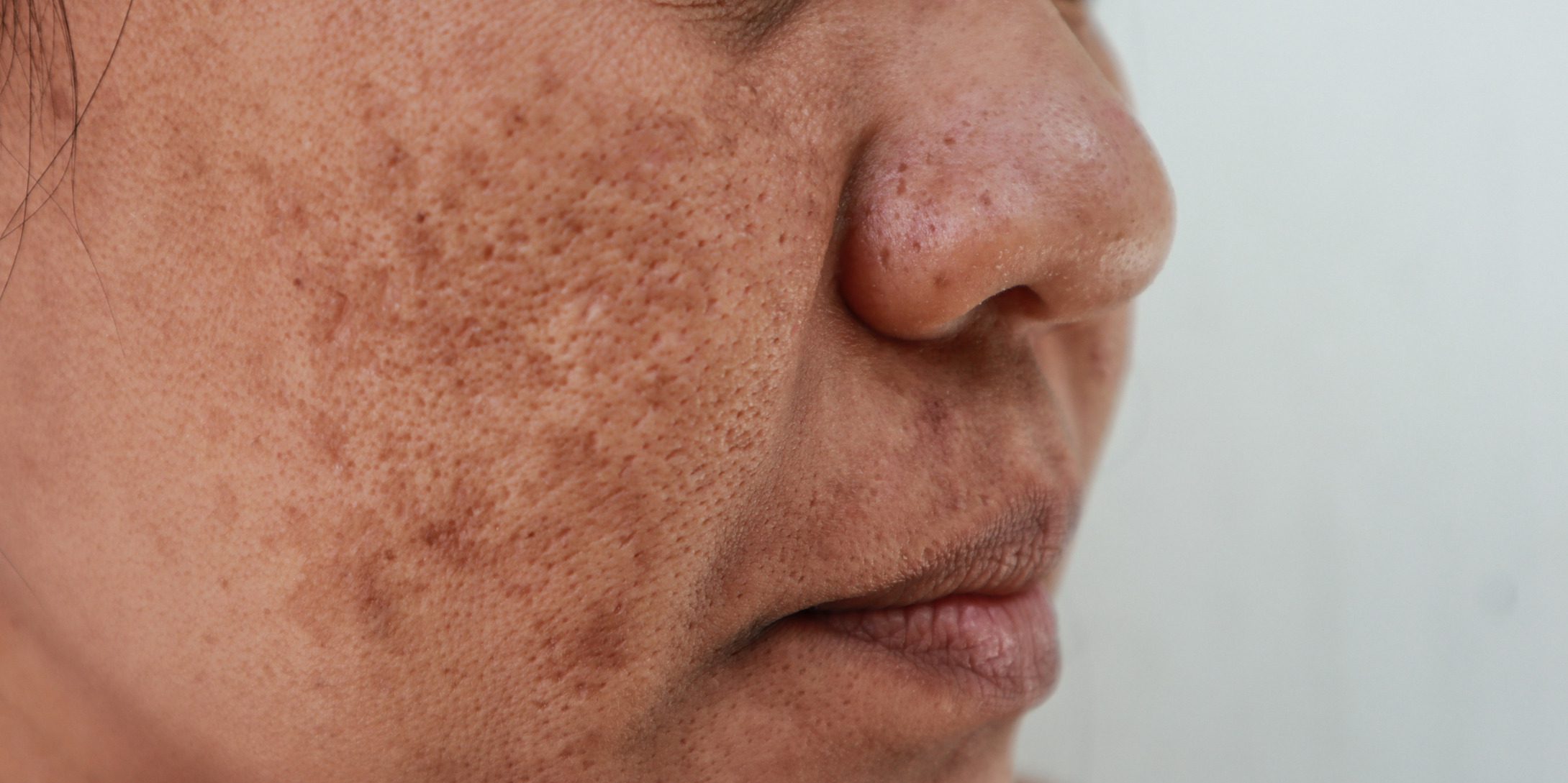Melasma
