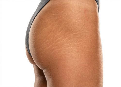 Photo of stretch marks on a woman's buttock