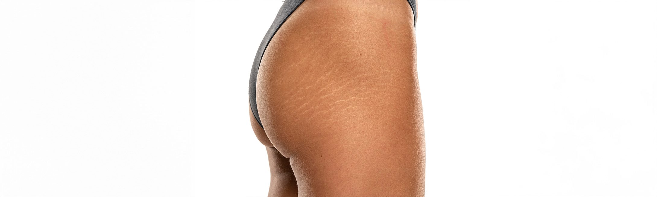 Stretch Marks