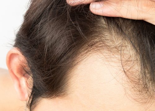 Photo of thinning hair on a man's head