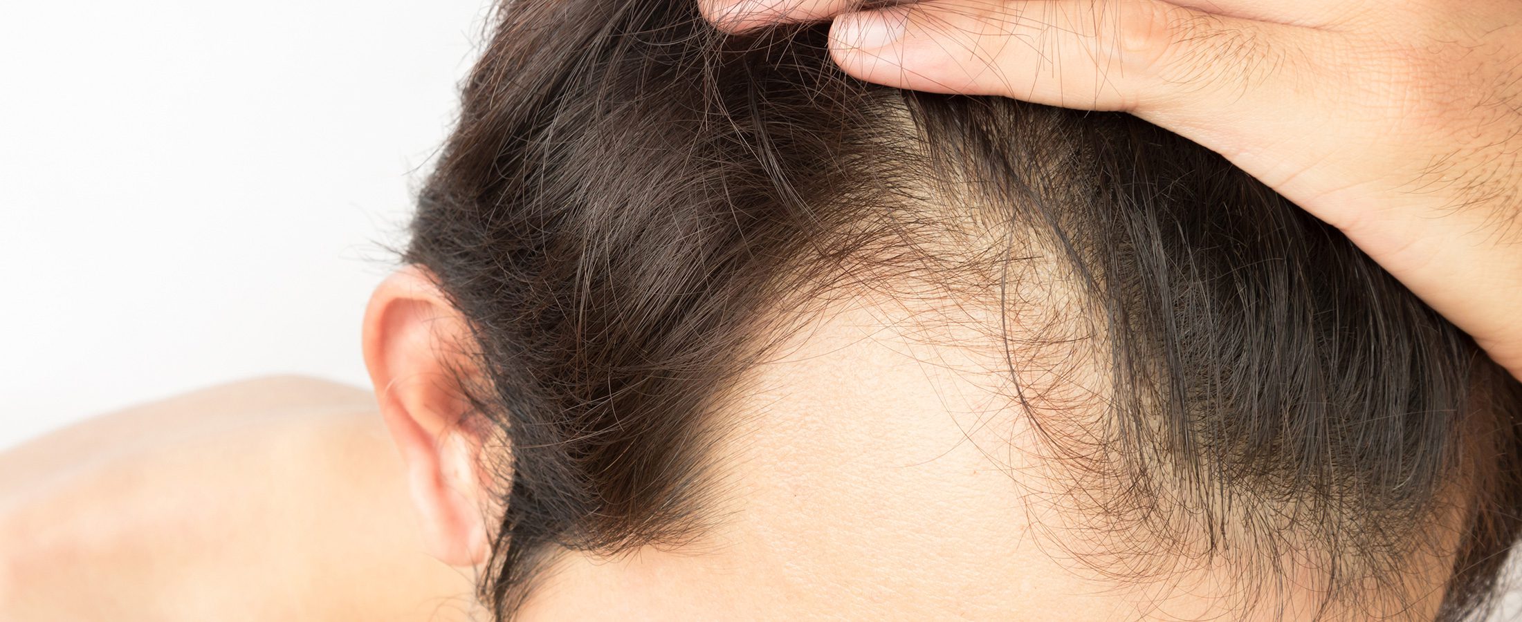 Thinning Hair
